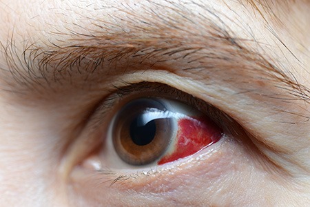 mixing pine-sol and bleach can result in eye damage